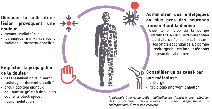 Techniques interventionnelles de prise en charge de la douleur : Diminuer la taille d'une lésion provoquant une douleur ; Empêcher la propagation de la douleur ; Administrer des antalgiques au plus près des neurones transmettant la douleur ; Consolider un os cassé par une métastase